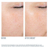 AlphaRet Exfoliating Pads Before and after comparison of skin texture with text indicating a 3-week treatment effect.