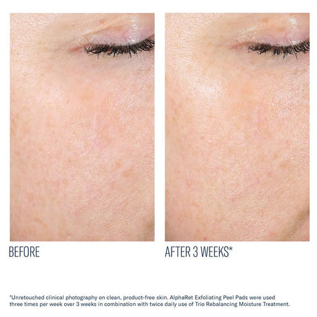 AlphaRet Exfoliating Pads Before and after comparison of skin texture with text indicating a 3-week treatment effect.