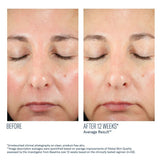 Before and after comparison of a person's face with text indicating a 12-week improvement while taking SkinBetter BioRewind Skin Health Dietary Supplement