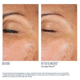 Before and after comparison of eye area skin texture on a person's eyelid after using EyeMax AlphaRet