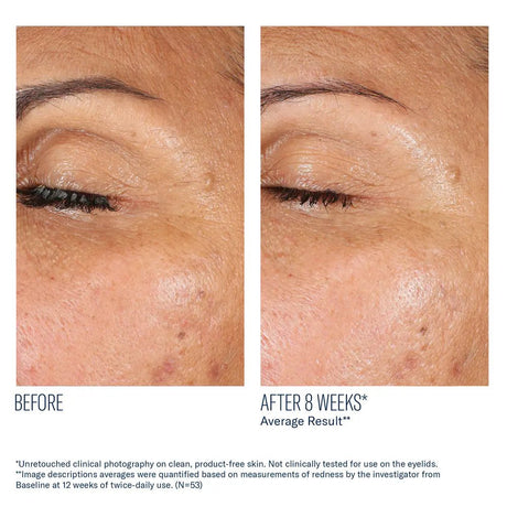 Before and after comparison of eye area skin texture on a person's eyelid after using EyeMax AlphaRet