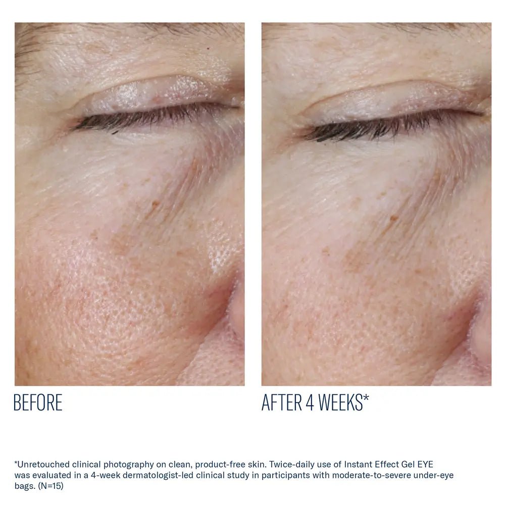 Before and after comparison of under-eye skin with text indicating improvement after 4 weeks using SkinBetter Instant Effect Gel EYE