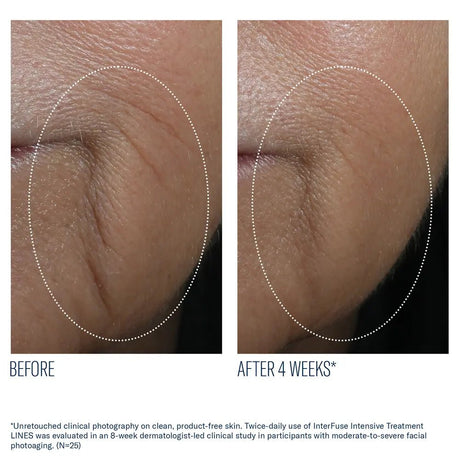 Before and after comparison of facial lines on skin with text indicating a 4-week treatment effect using SkinBetter InterFuse Intensive Treatment Lines 