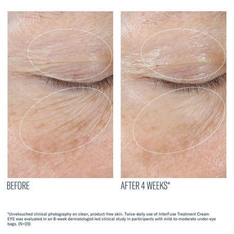 SkinBetter InterFuse Intensive Treatment Eyes before and after less wrinkles results