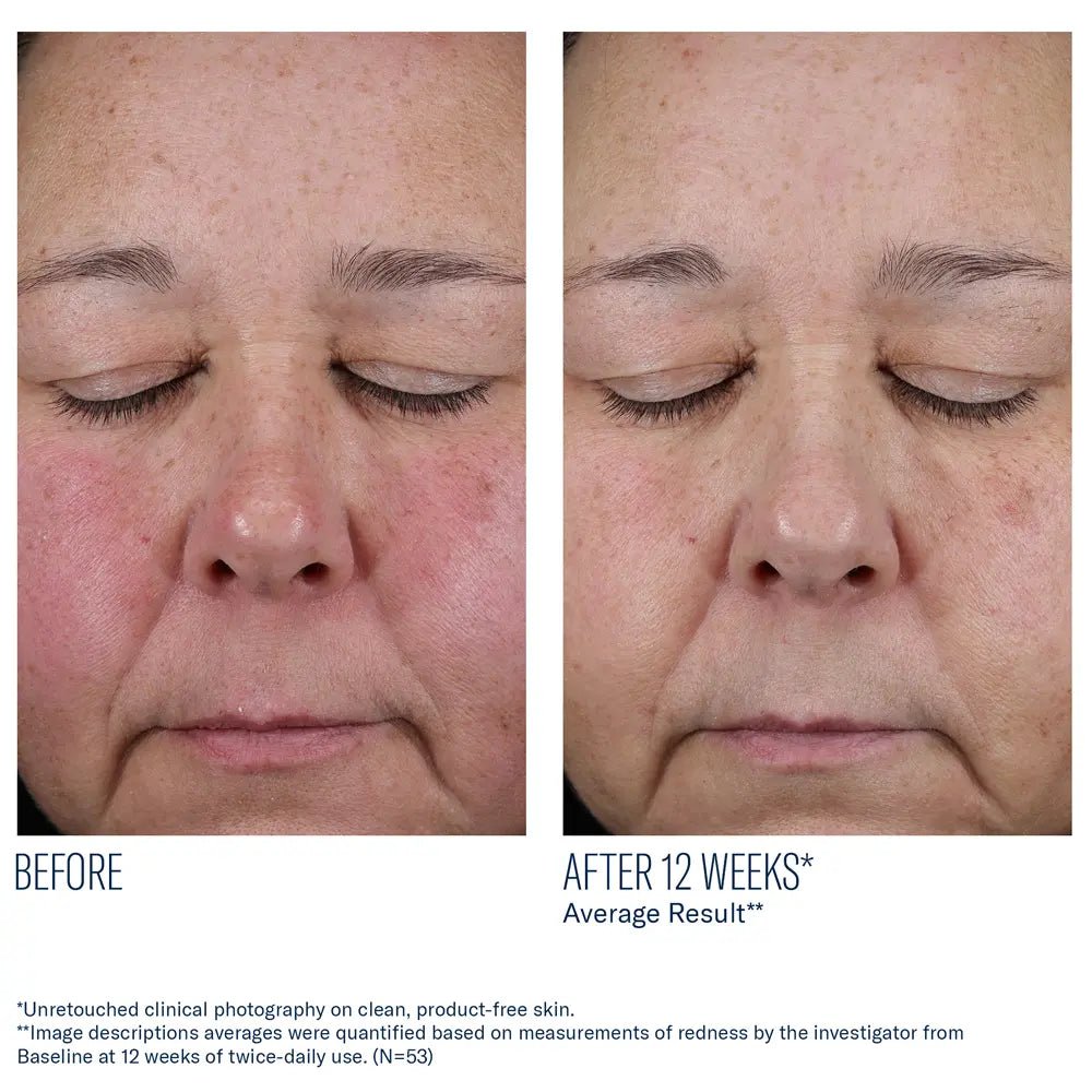 Before and after comparison of a person's face with closed eyes, showing reduced redness after 12 weeks using SkinBetter Mystro Active Balance Serum.