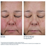 Before and after comparison of a person's face with closed eyes, showing reduced redness after 12 weeks using SkinBetter Mystro Active Balance Serum.