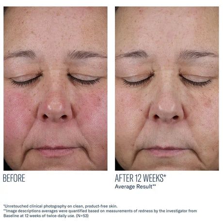 Before and after comparison of a person's face with closed eyes, showing reduced redness after 12 weeks using SkinBetter Mystro Active Balance Serum.