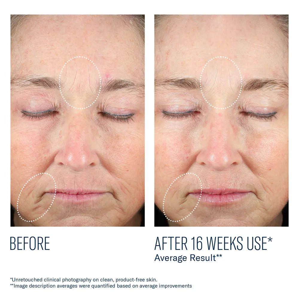 Before and after comparison of facial skin with visible improvements after 16 weeks using SkinBetter Mystro Revive Renewing Serum