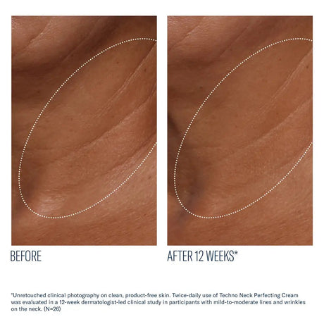 SkinBetter Techno Neck Perfecting Cream  before after resulls rejuvenated neck