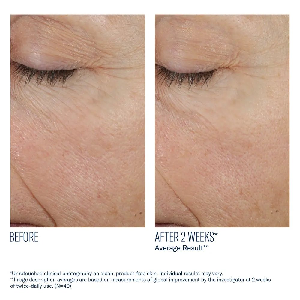 Before and after comparison of eye area skin texture improvement on a person's eyelid with SkinBetter Trio Rebalancing Moisture Treatment
