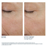 Before and after comparison of eye area skin texture improvement on a person's eyelid with SkinBetter Trio Rebalancing Moisture Treatment