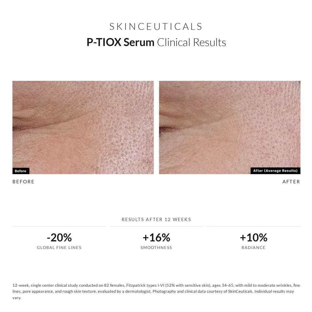 SkinCeuticals P-Tiox Anti-Wrinkle Serumb before and after less pores results
