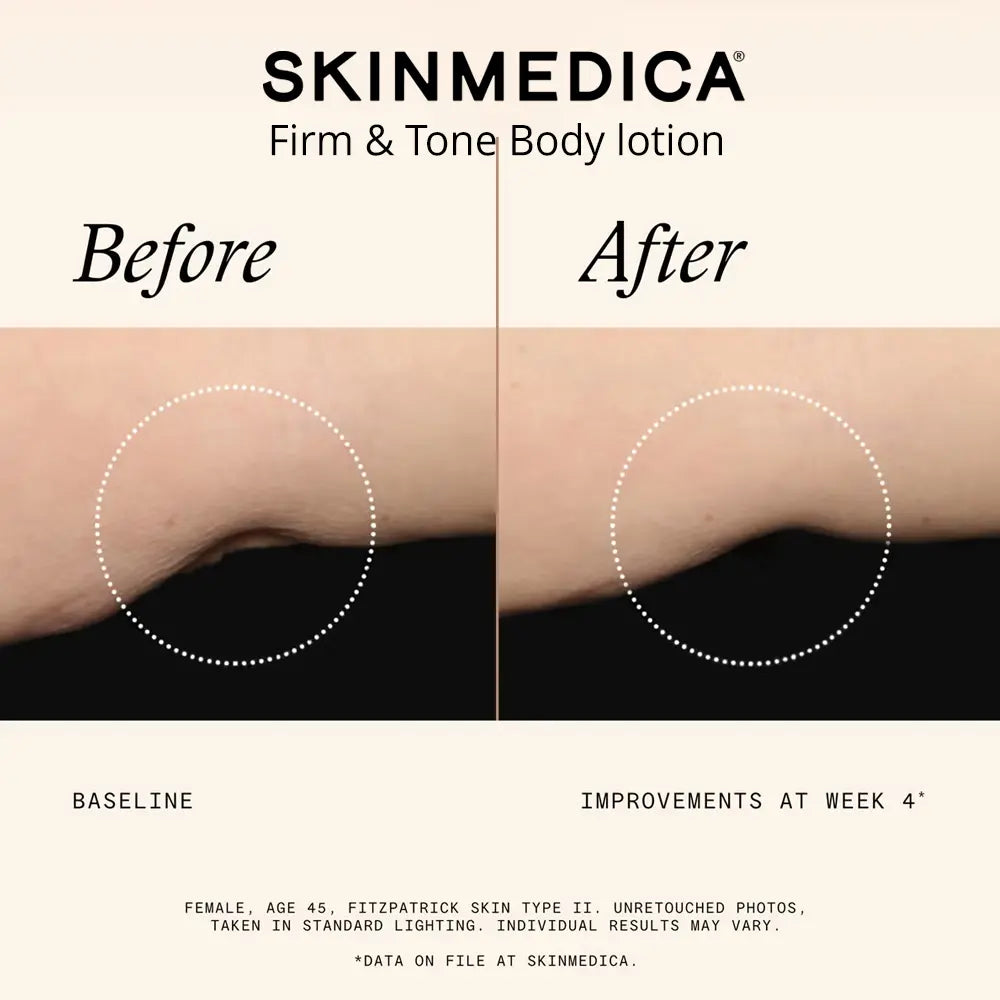 Before and after comparison graphic for SkinMedica Firm & Tone Body lotion, showing a close-up of a creased skin fold on an arm with text and a black background.