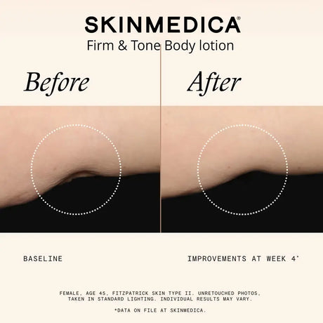 Before and after comparison graphic for SkinMedica Firm & Tone Body lotion, showing a close-up of a creased skin fold on an arm with text and a black background.