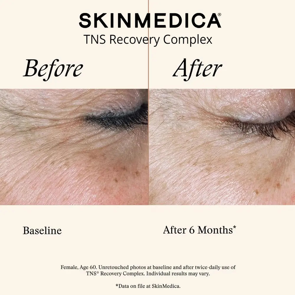 Before and after skin comparison for SKINMEDICA TNS Recovery Complex, showing a close-up of a wrinkled eye area at baseline and smoother skin at after 6 months.