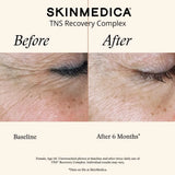 Before and after skin comparison for SKINMEDICA TNS Recovery Complex, showing a close-up of a wrinkled eye area at baseline and smoother skin at after 6 months.